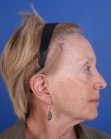 After Hair Transplant&nbsp;Hair Thinning